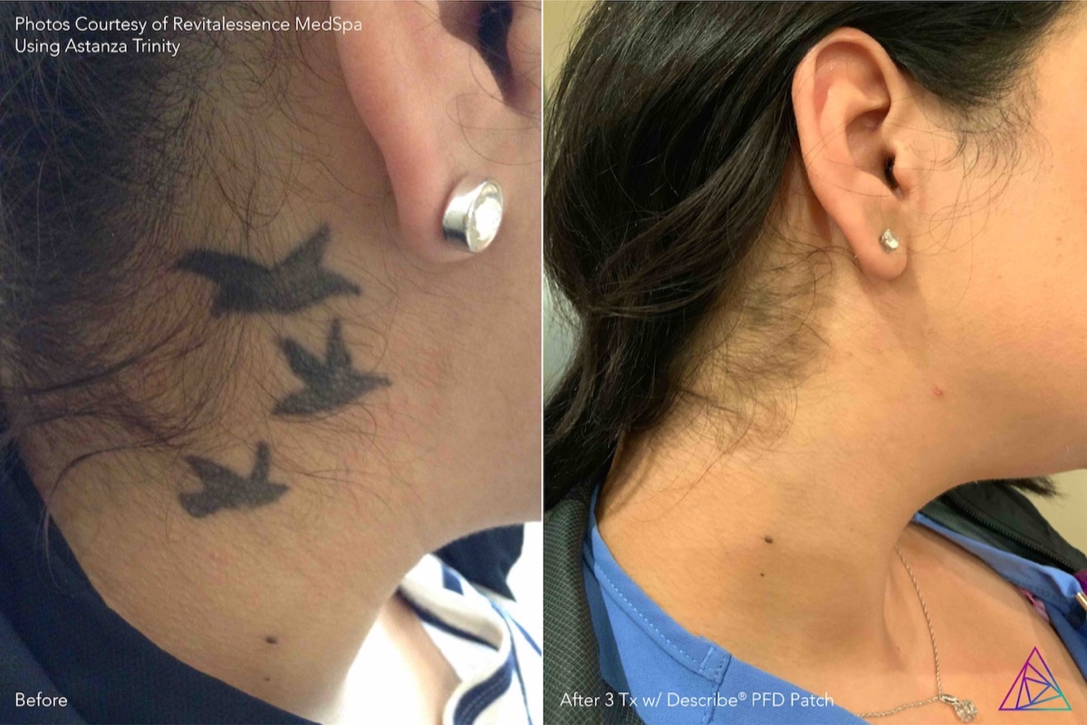 Completed bird tattoo removal example credited to Revitalessence MedSpa using Astanza Trinity