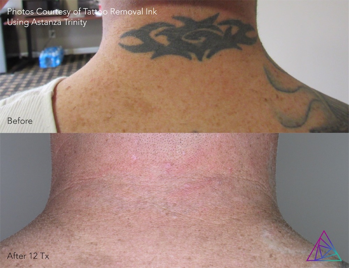 Completed neck tattoo removal example credited to Tattoo Removal Ink using Astanza Trinity