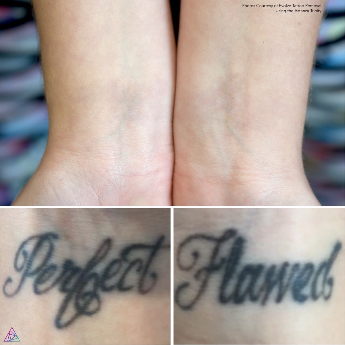 Completed wrist tattoo removal examples credited to Evolve Tattoo Removal using Astanza Trinity