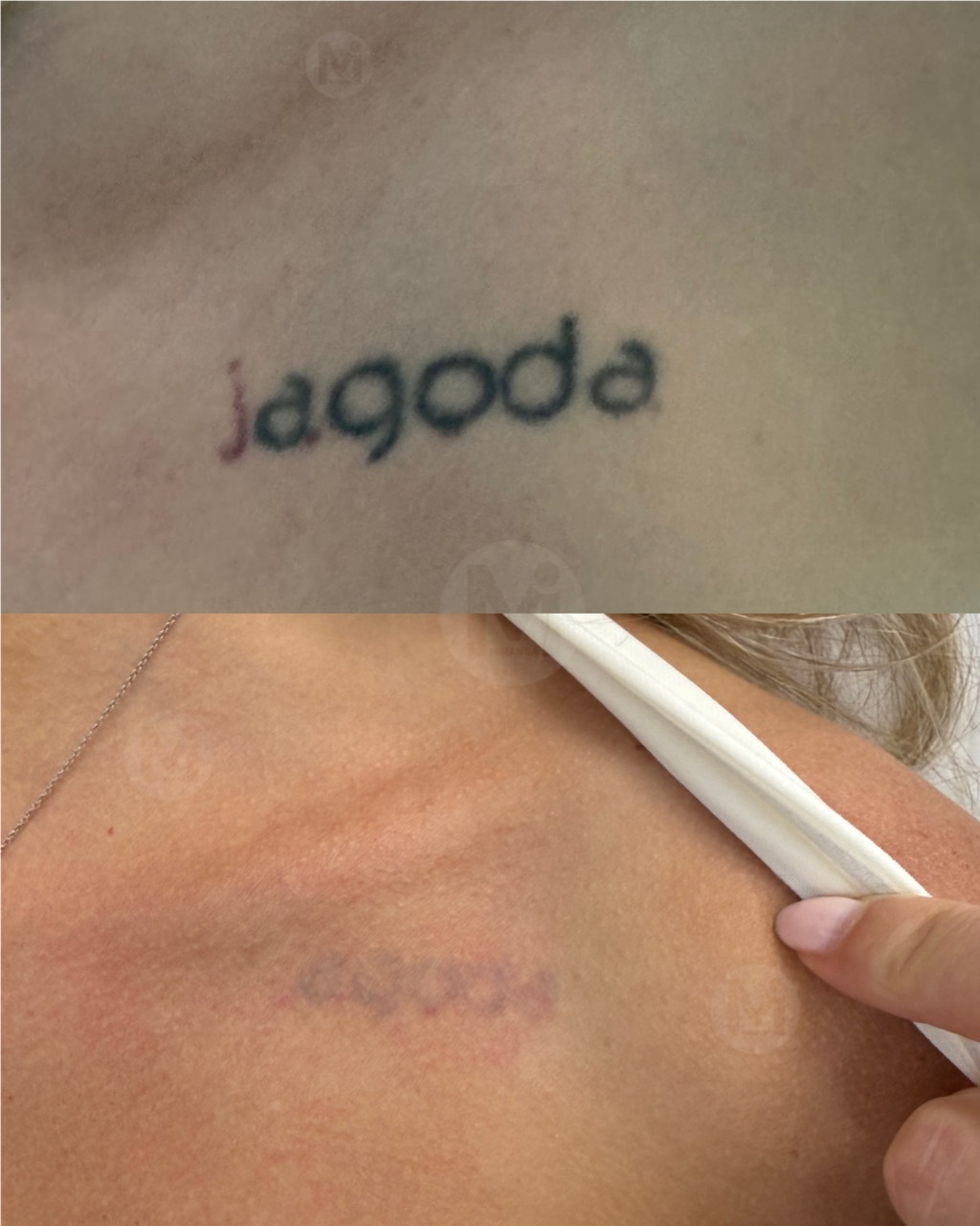 Body tattoo removal before and after progress