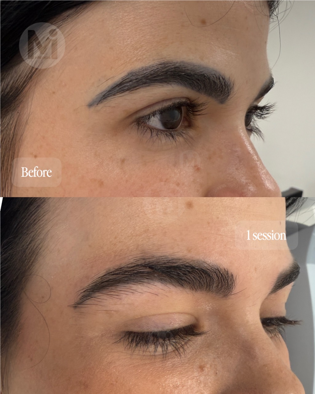 Eyebrow permanent makeup removal progress after one session