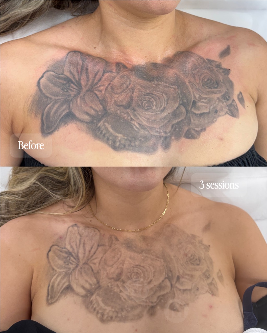 Chest tattoo removal progress after three sessions