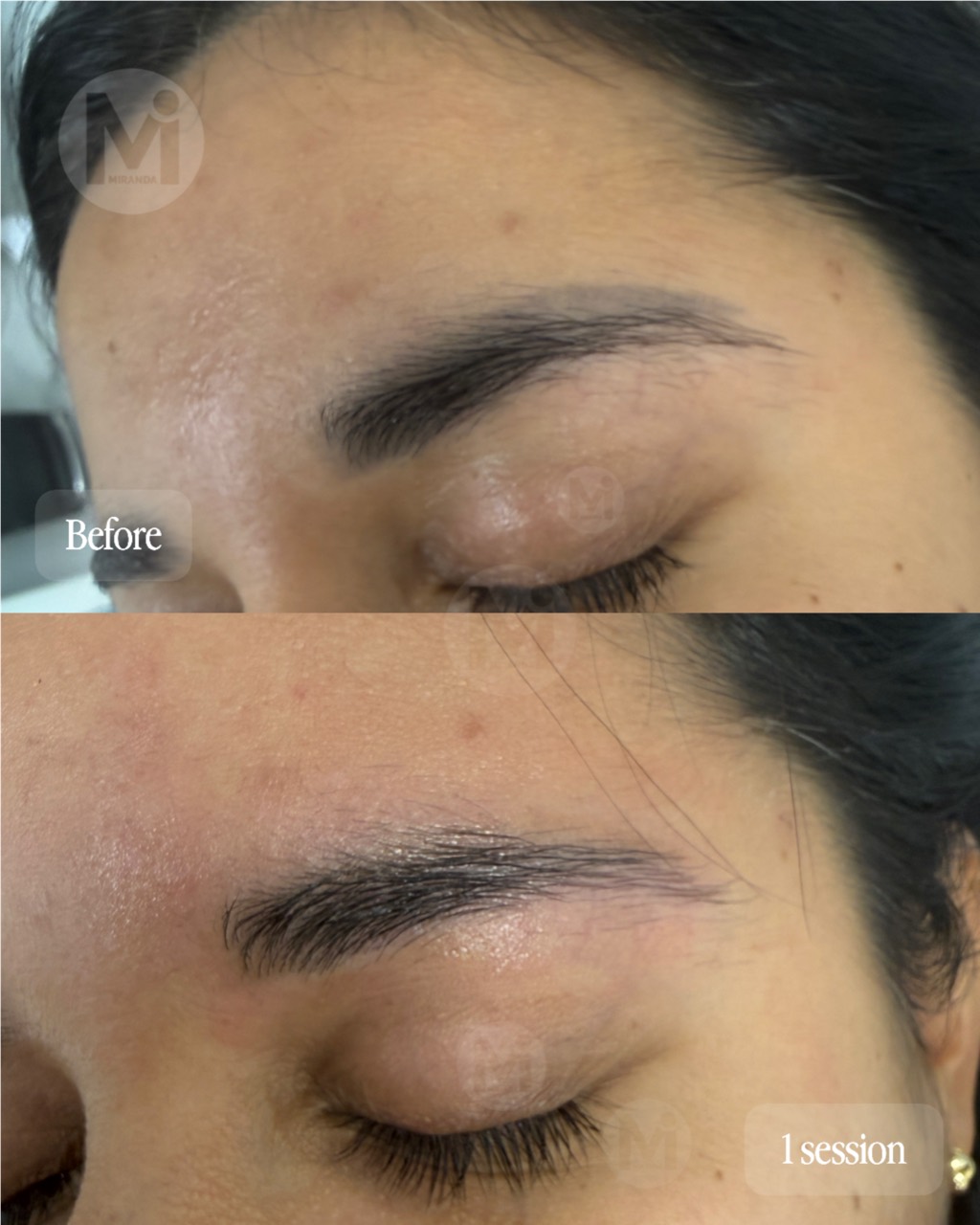 Eyebrow permanent makeup removal progress after one session