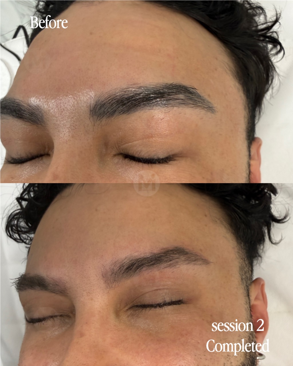 Eyebrow permanent makeup removal completed after two sessions