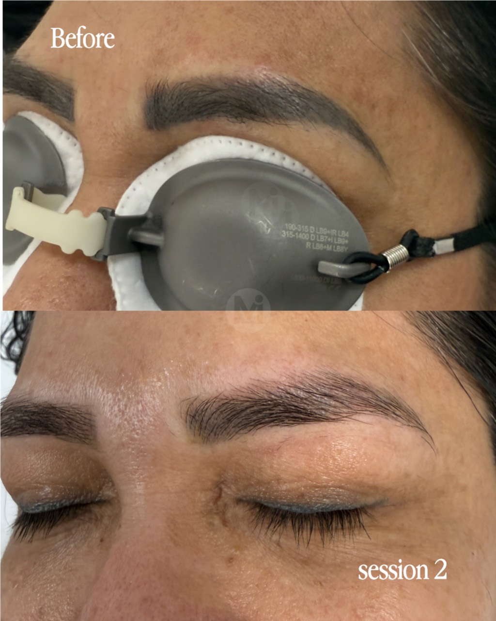 Eyebrow permanent makeup removal progress after two sessions