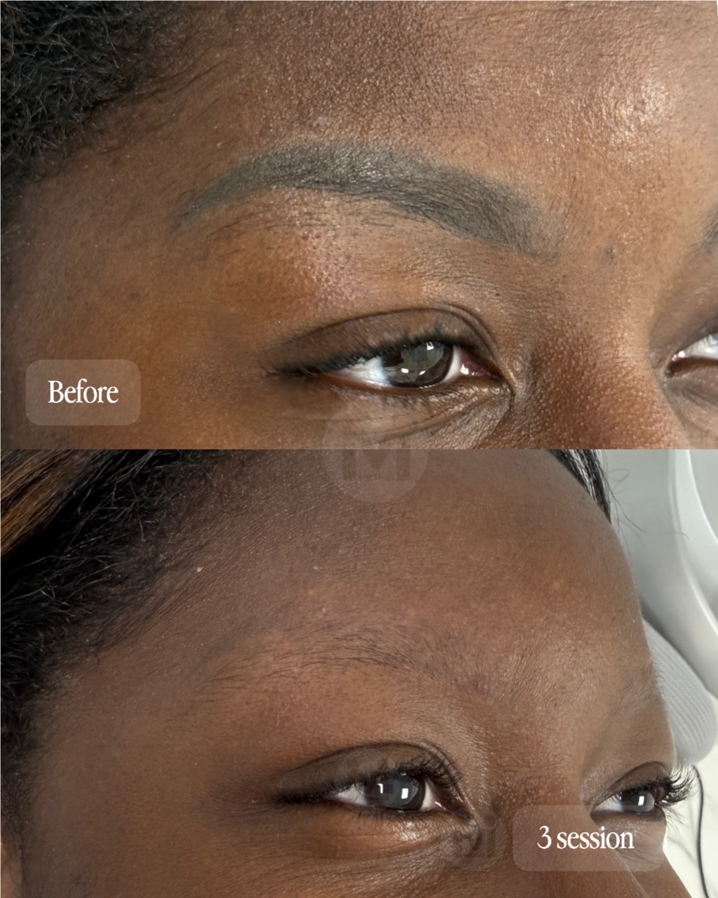 Eyebrow permanent makeup removal progress after three sessions on dark skin