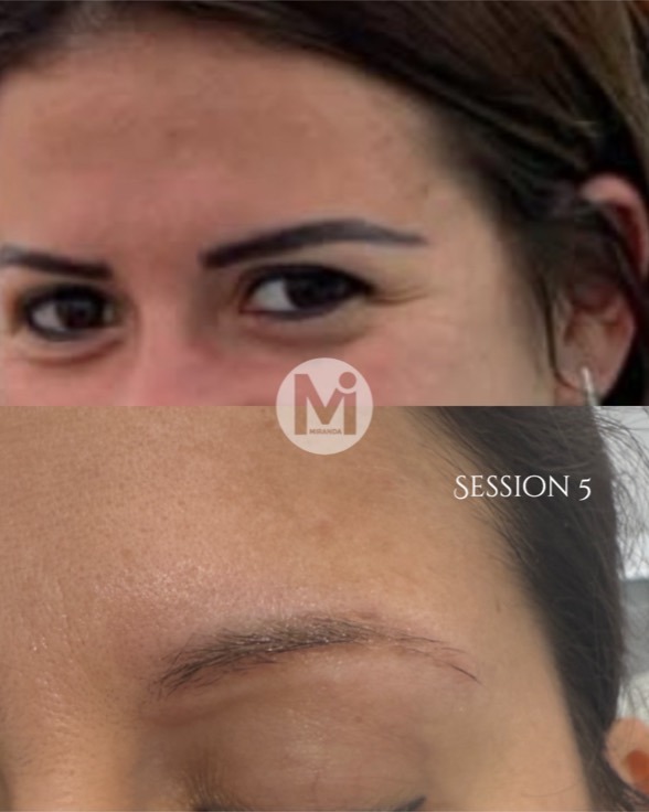 Eyebrow permanent makeup removal progress after five sessions