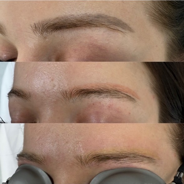 Eyebrow permanent makeup removal treatment stages