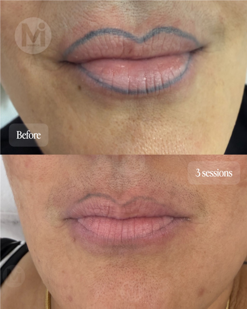 Lip liner permanent makeup removal progress after three sessions