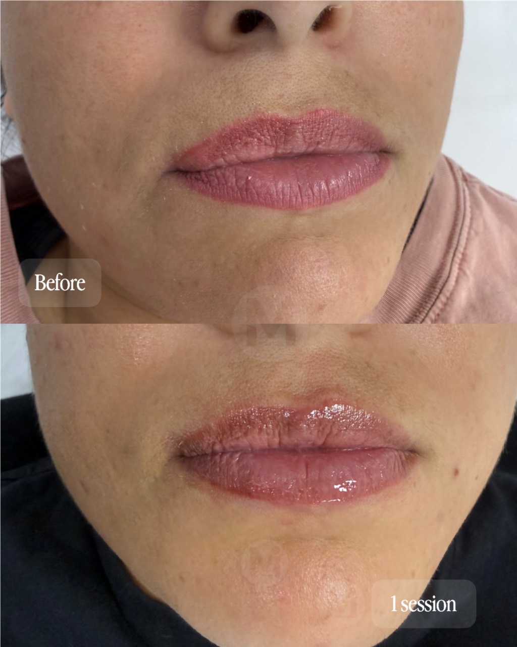 Lip permanent makeup removal progress after one session