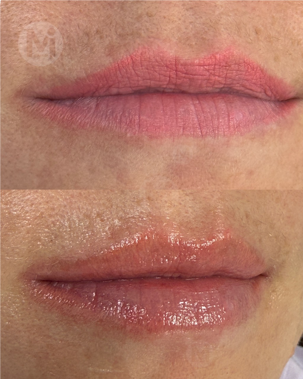 Lip permanent makeup removal before and after result