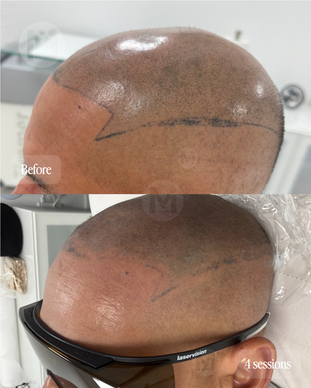 Scalp permanent makeup removal progress after four sessions