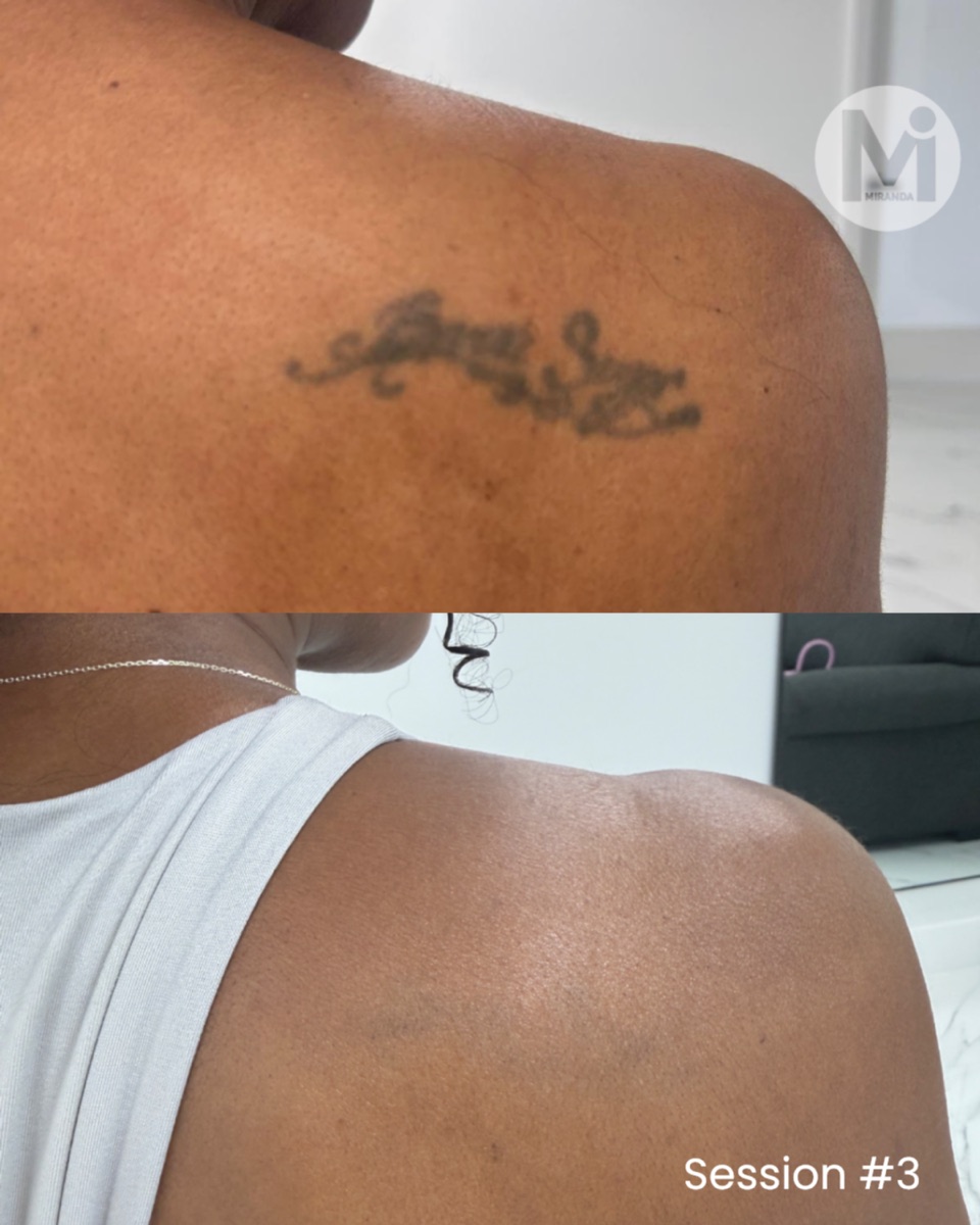 Tattoo removal progress on dark skin after three sessions